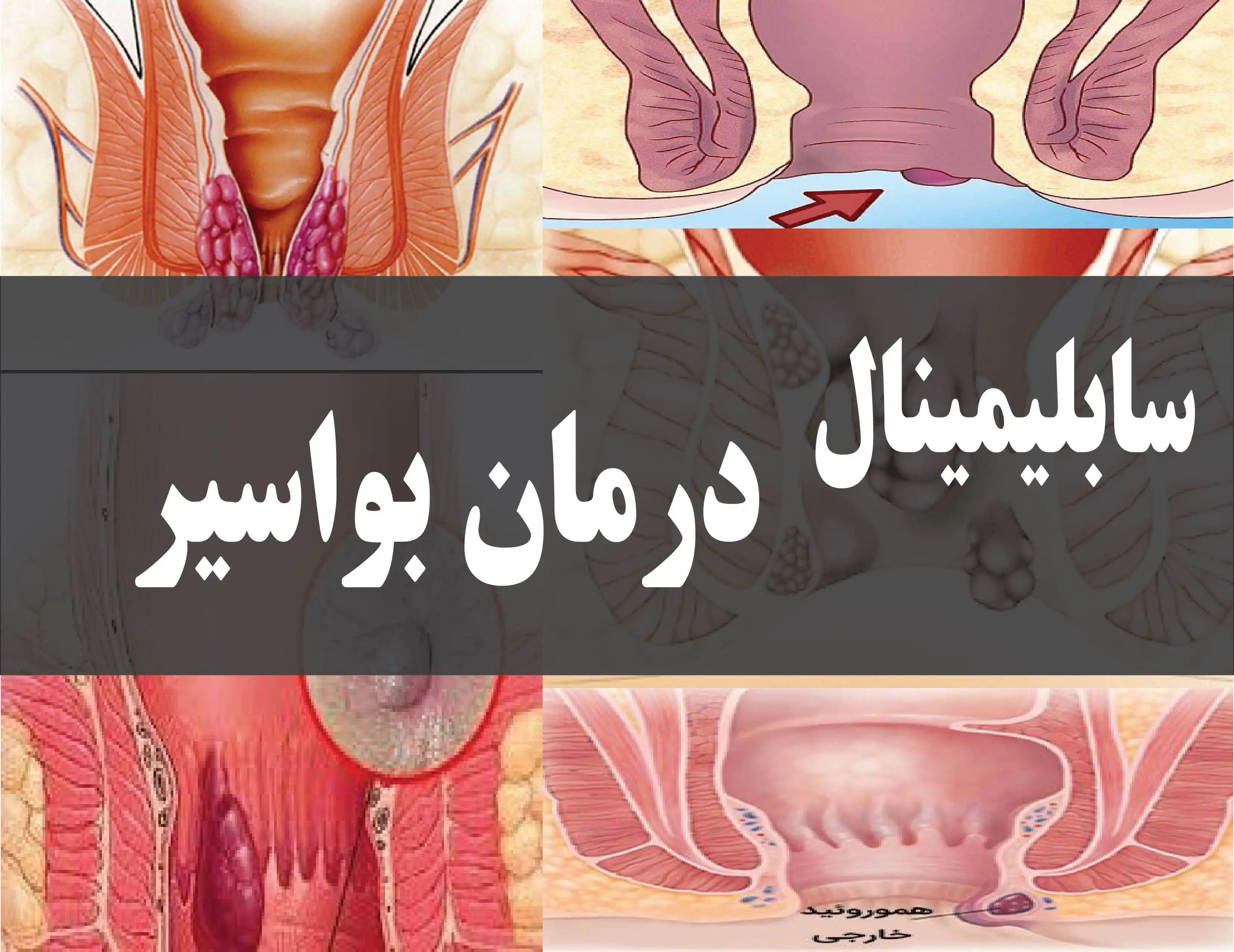 دانلود فایل سابلیمینال درمان بواسیر | فاپول