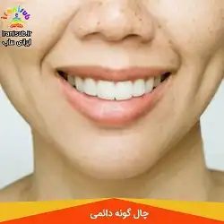 سابلیمینال چال گونه